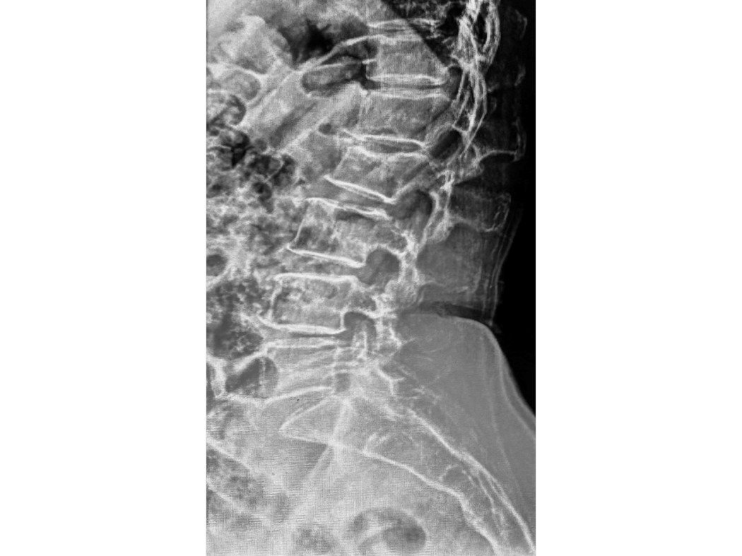 X-ray on arrival showing reduced disc space at L1-L2 and L4-L5, with partial straightening of the lumbar spine. Spine Surgery specialist in Delhi.