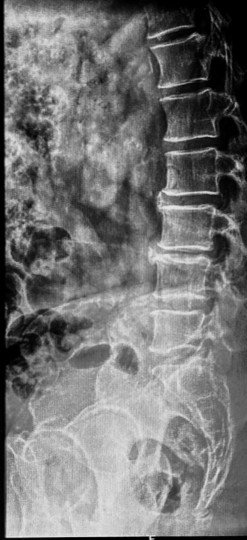 X-ray on arrival showing degenerative changes across the lumbar spine.