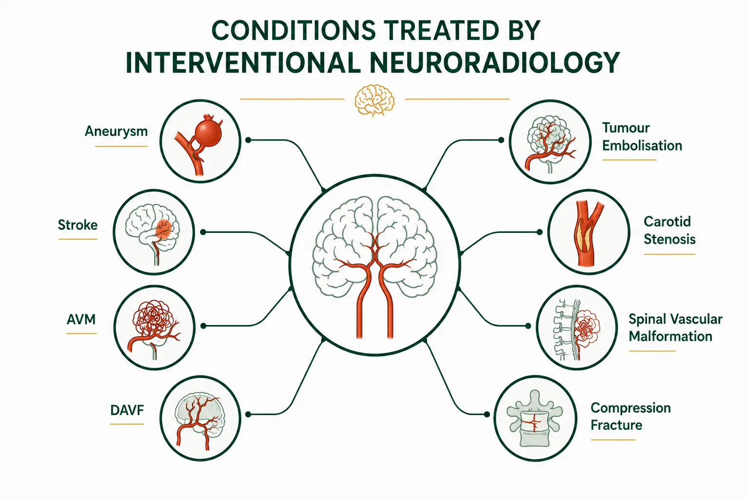 Infographic showing neurological conditions treated by interventional neuroradiology, including aneurysm, stroke, AVM, and DAVF. Interventional Neuroradiology Treatment in Delhi
