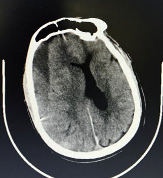 Post-operative CT scan confirming coil embolisation of the right middle meningeal artery, post-operative changes visible along right parieto-temporal convexity.