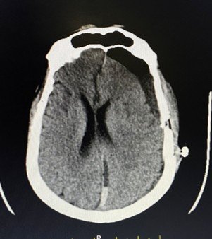 Post-operative CT scan showing left parietal burr hole changes with drainage catheter in situ, residual collection present as expected in the early post-operative period.