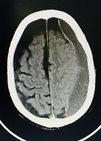 Post-operative CT scan confirming successful embolisation with changes in the haematoma consistent with early reabsorption.
