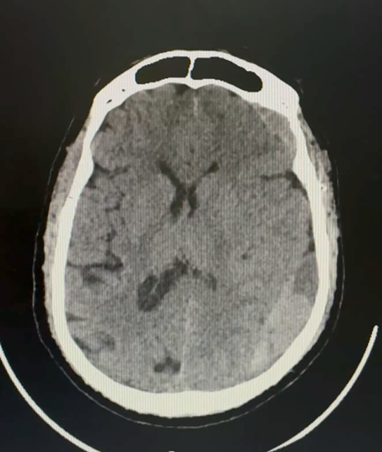 Post-operative CT scan confirming reduction in brain swelling and mass effect, with decreased midline shift, evidence of early response to embolisation.
