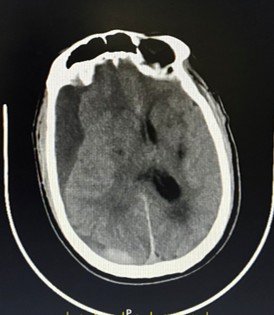 CT scan showing large right-sided subdural haematoma, mixed density collection indicating acute bleeding on top of a chronic bleed, with brain shift.
