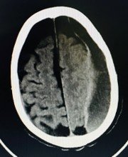 CT scan showing left hemispheric chronic subdural haematoma, a slow accumulation of old blood between the brain and its outer covering.
