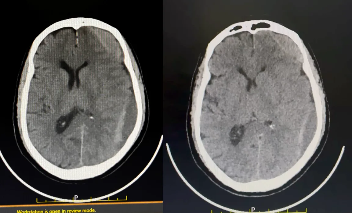 CT scan showing large left-sided subdural haematoma with mixed density, indicating acute bleeding on top of a chronic collection.