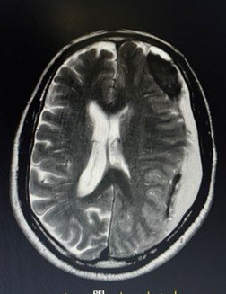 MRI brain showing bilateral subdural haematoma collections along both cerebral convexities, left greater than right.