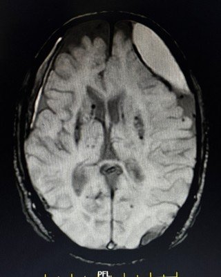 MRI brain showing left hemispheric chronic subdural haematoma with right frontal subacute SDH, chronic lacunar infarcts and ischaemic changes.