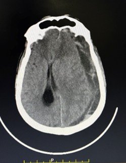 CT scan showing large left-sided subdural haematoma, mixed density collection over the fronto-parieto-temporal region, indicating acute bleeding on top of a chronic collection.