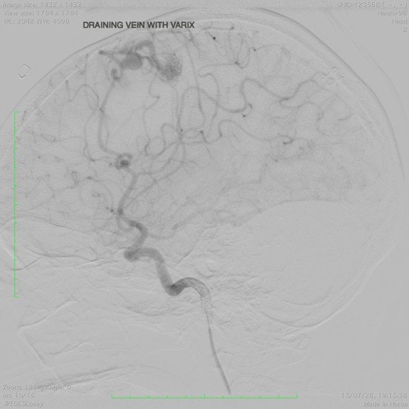 Digital Subtraction Angiography confirming the vascular abnormality and guiding the embolisation procedure.