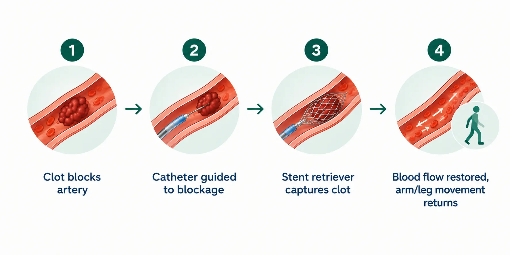 Infographic showing the 4 steps of mechanical thrombectomy for stroke: clot blockage, catheter insertion, stent retriever clot removal, and restored blood flow