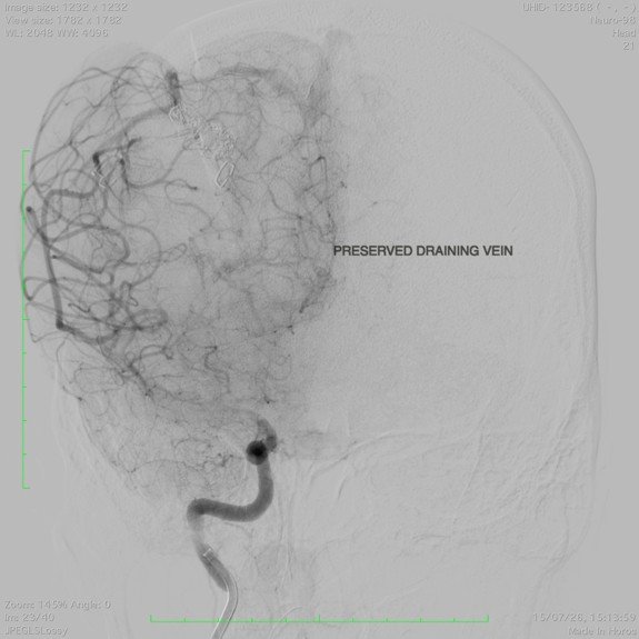 Post-embolisation imaging confirming successful closure of the abnormal blood vessel.