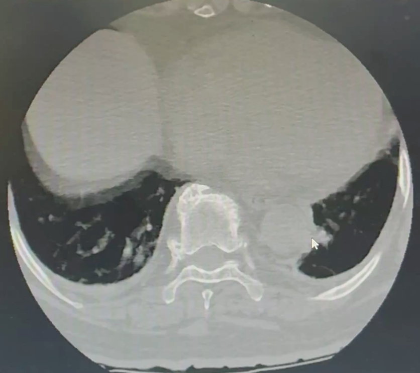 Post-op CT confirming well-positioned C3-C6 lateral mass screws and adequate decompression at the operated levels.
