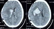 Post-operative CT scan confirming decompression achieved with the hemicraniectomy and resolution of immediate mass effect.
