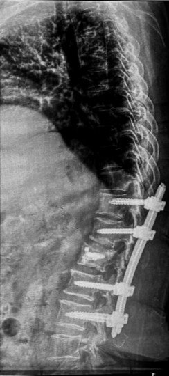 Post-operative X-ray confirming metallic implants and screws correctly positioned at L1 with fixation at D11, D12, L2, and L3.