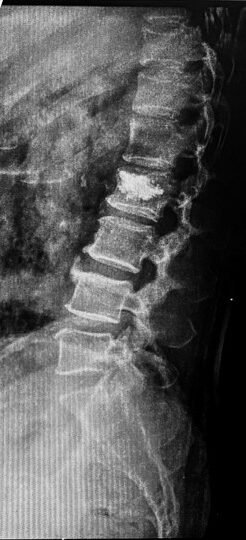 Post-operative X-ray confirming vertebroplasty changes at L2 with cement fill visible, partial straightening of lumbar spine noted.
