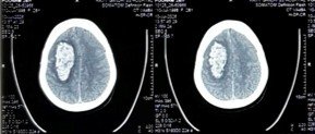 CT scan on arrival showing significant right-sided brain haemorrhage with mass effect and midline shift.