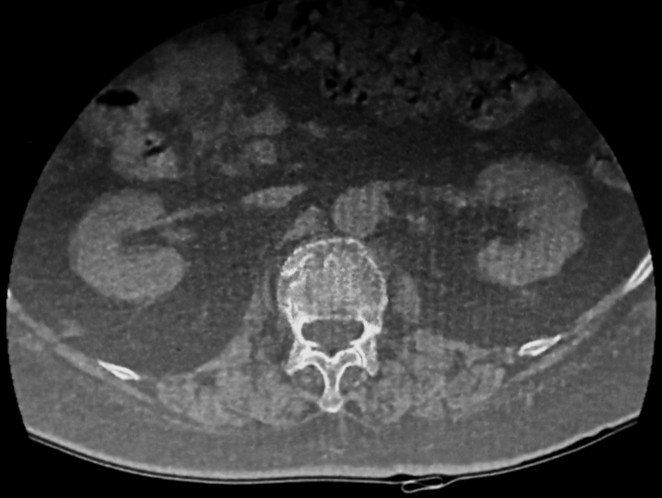 CT scan confirming L1 compression fracture with superior endplate collapse and disc bulges at multiple lumbar levels.