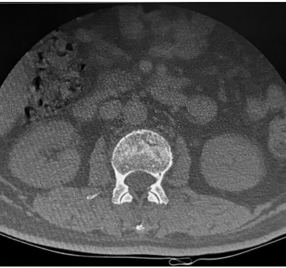 CT scan confirming wedge compression fracture of L2 with superior endplate collapse and facet joint changes at multiple levels.
