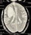 CT angiography mapping the blood vessel abnormality responsible for the haemorrhage, essential for planning embolisation.