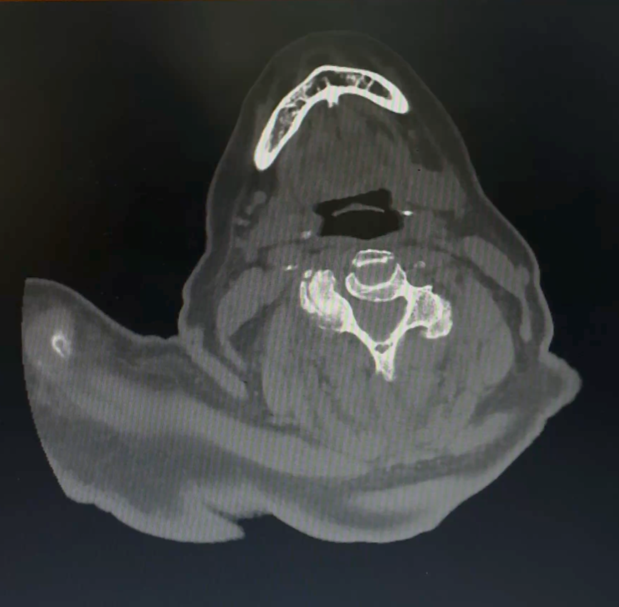 Pre-op CT delineating the bony anatomy and confirming multilevel canal narrowing prior to surgical planning.