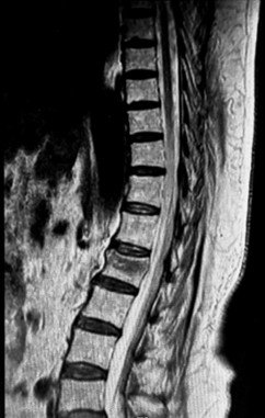 MRI showing L1 vertebral body compression fracture with superior endplate collapse and degenerative disc changes across multiple levels.
