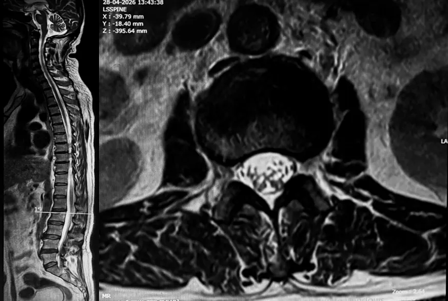 MRI showing L2 compression fracture with partial loss of lumbar lordosis and disc degeneration across multiple levels.