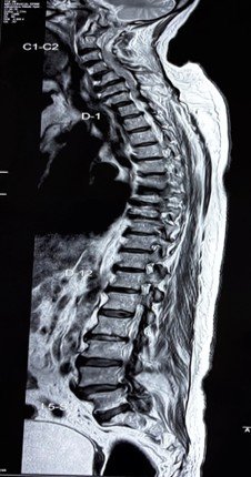 Pre-op MRI confirming C3-C4-C5 canal stenosis with cord signal changes consistent with myelopathy.