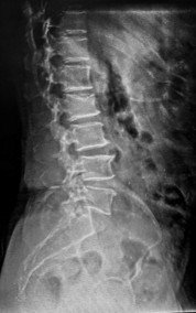 X-ray on arrival showing anterior wedge compression fracture of the L2 vertebral body.