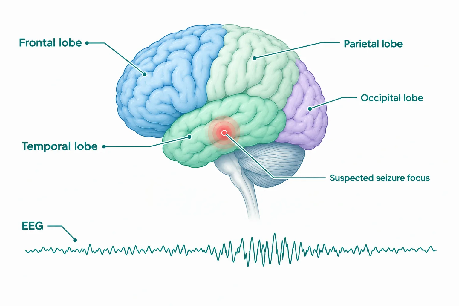 Labelled brain diagram showing the temporal lobe seizure focus and EEG wave in epilepsy