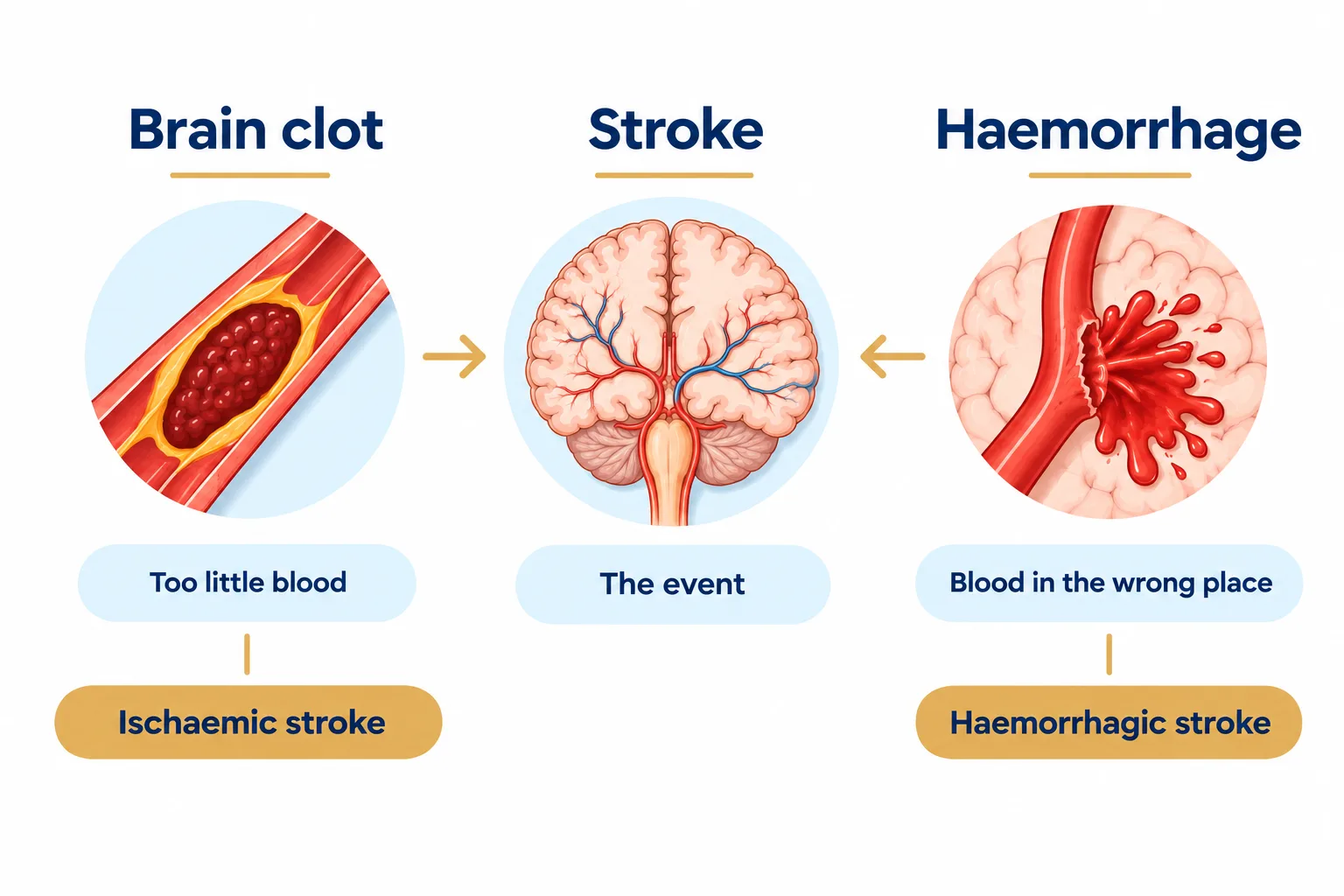 Infographic comparing a brain clot, a stroke and a brain haemorrhage, showing that clots and bleeds are the two causes of stroke